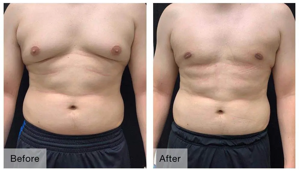 GYNECOMASTIA