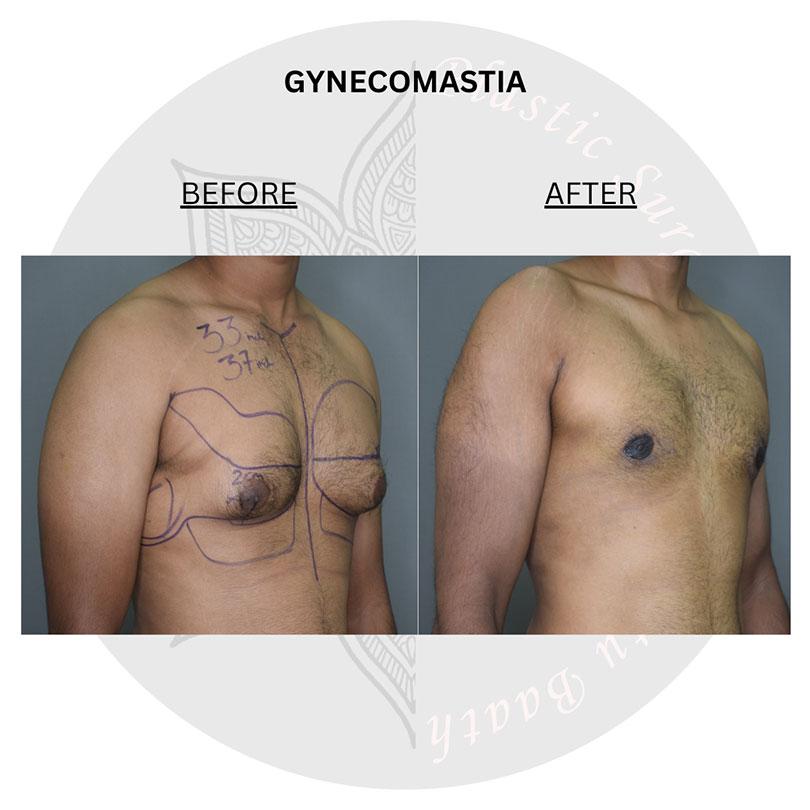 gynecomastia surgery before and after images