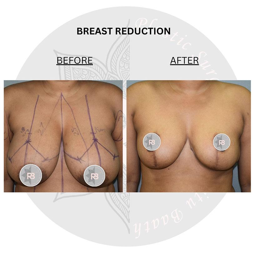 breast reduction surgery before and after images