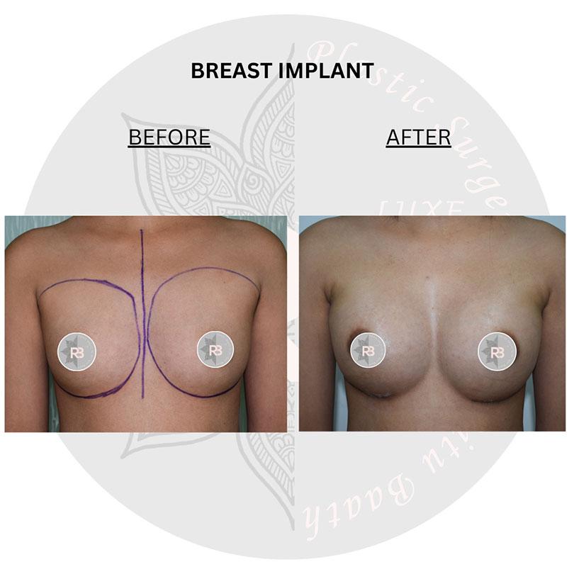 breast implant surgery before and after images