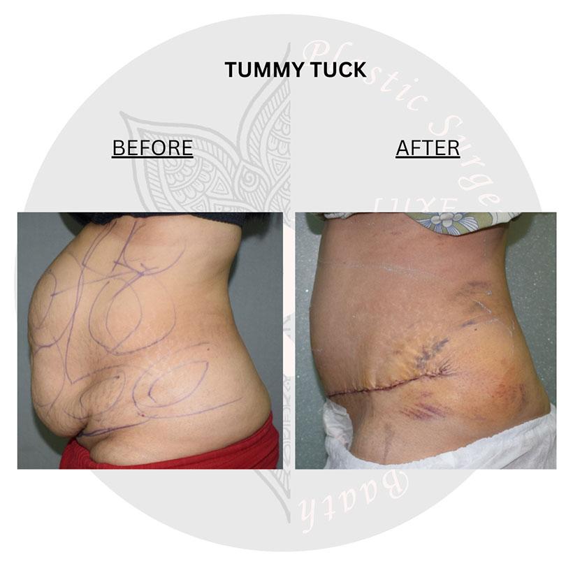 tummy tuck surgery before and after images