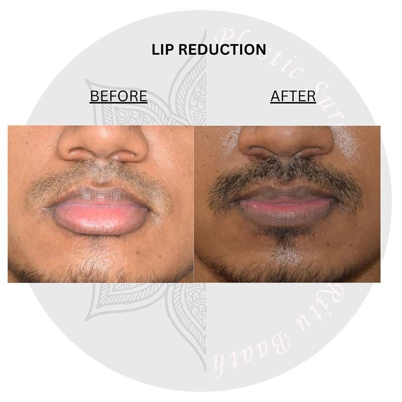 lip reduction surgery before and after images