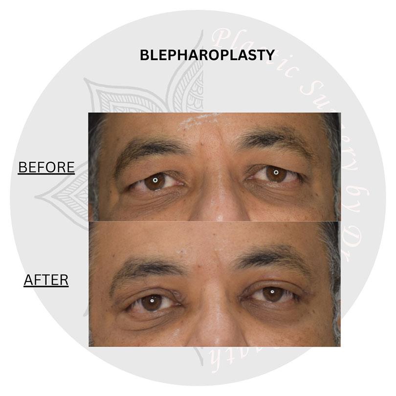 blepharoplasty surgery before and after images