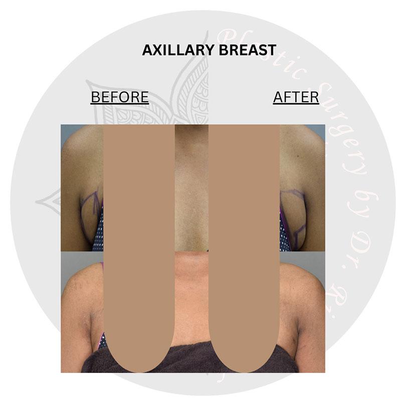 breast reduction surgery before and after images