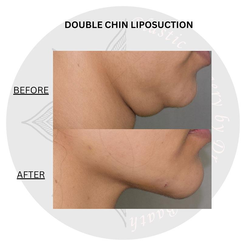 liposuction surgery before and after images