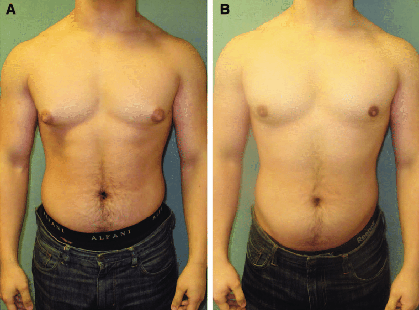 images-before-a-and-after-B-gynecomastia-surgery-in-a-patient-who-underwent