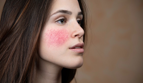 Causes and symptoms of Rosacea.