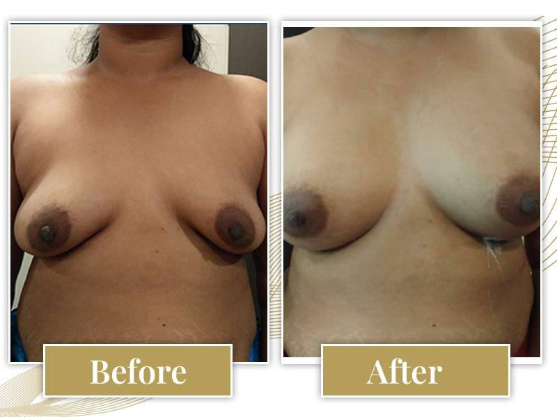 breast-augmentation01