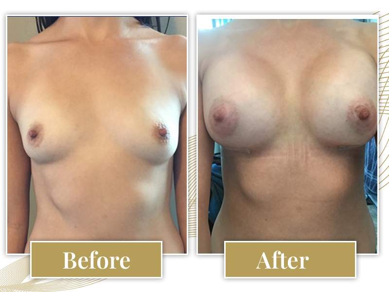 breast-augmentation02 (1)