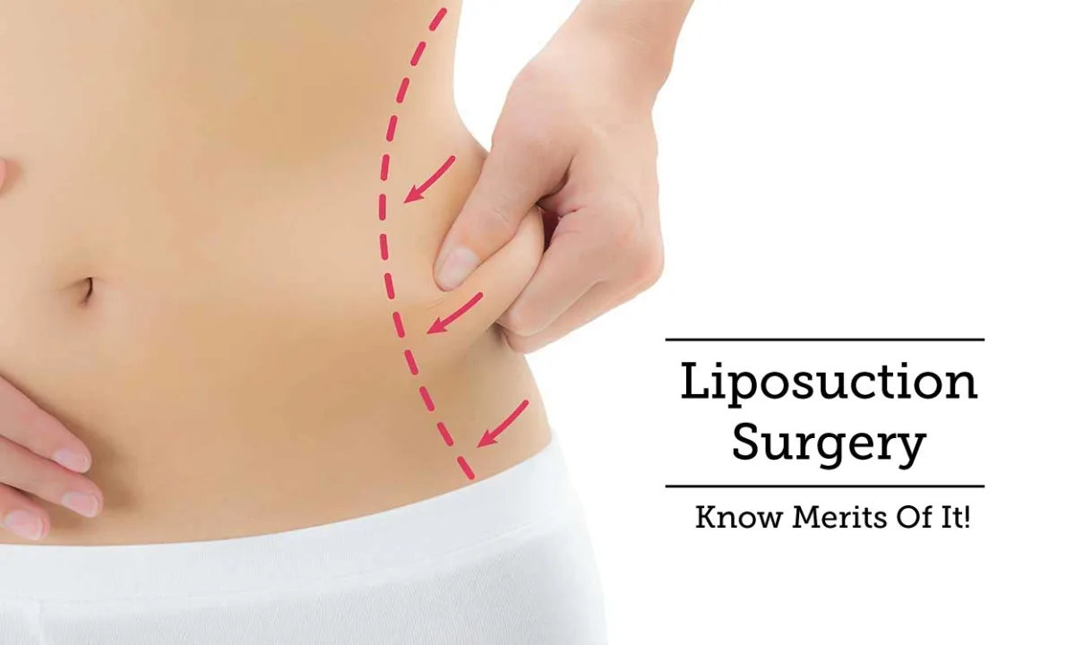 Are You An Ideal Candidate For The Liposuction Procedure? What To Expect?