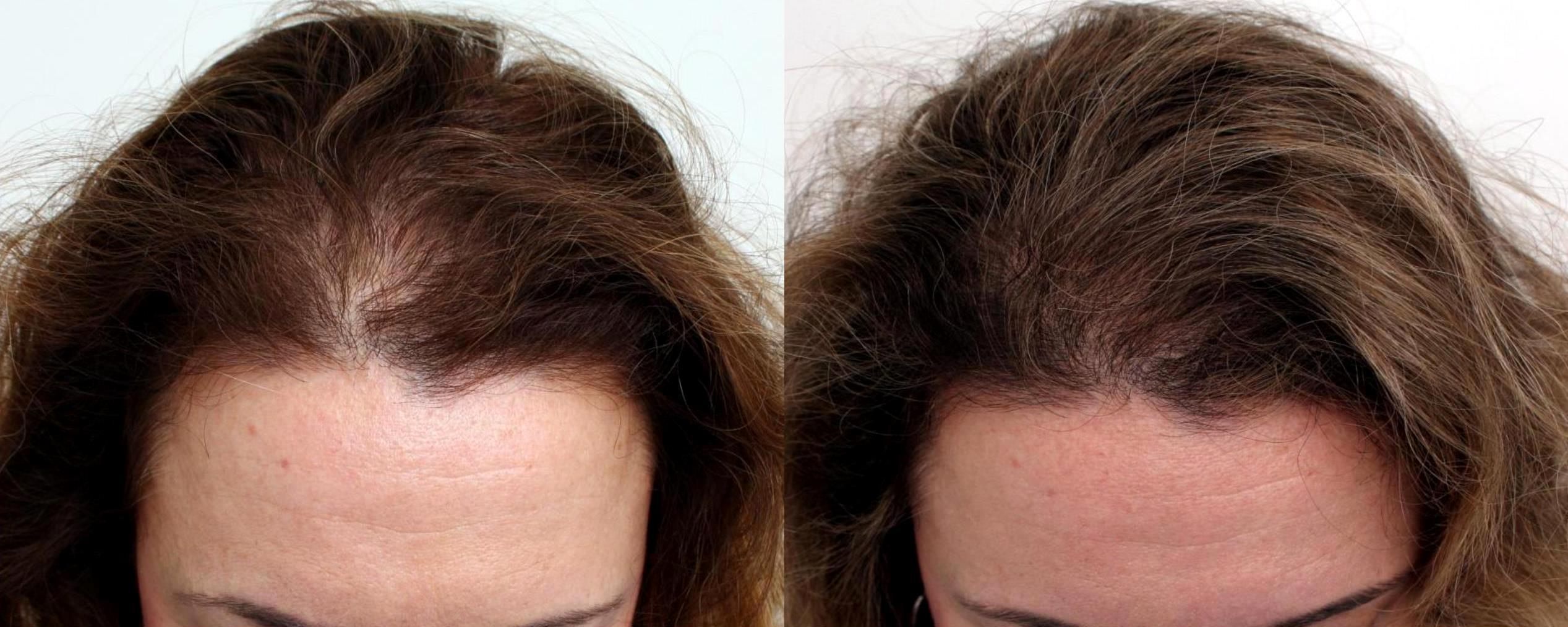 All about - Hair loss in women