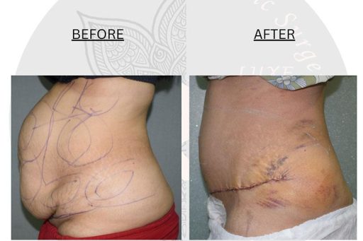 tummy tuck surgery before and after images